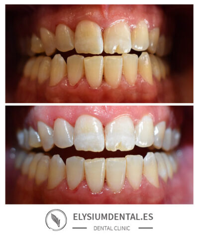 Blanqueamiento dental en Madrid
