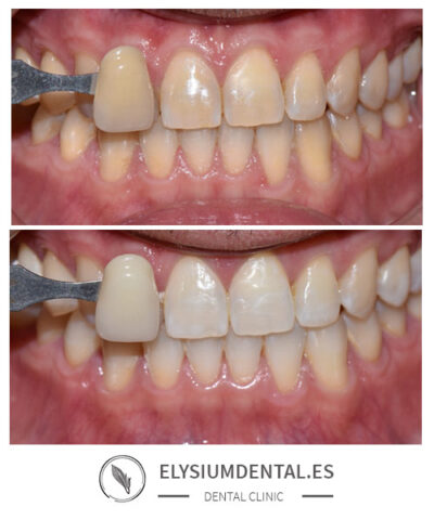 Blanqueamiento dental en Madrid