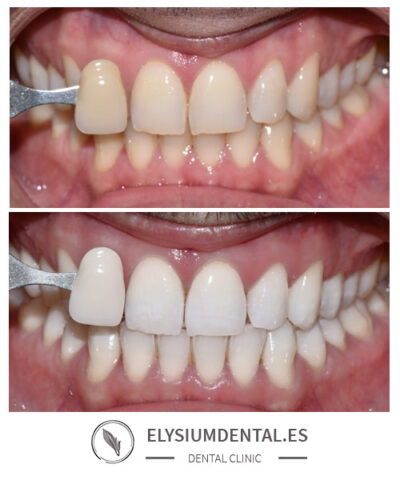 Blanqueamiento dental en Madrid