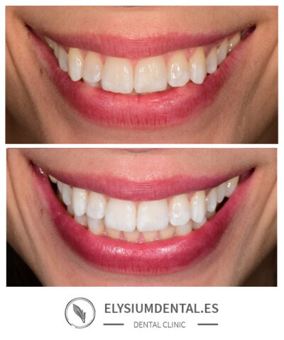 Blanqueamiento dental en Madrid