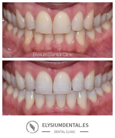 Blanqueamiento dental en Madrid