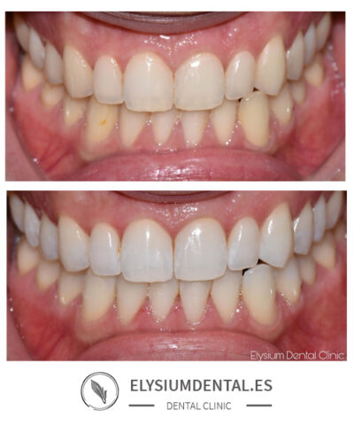 Blanqueamiento dental en Madrid