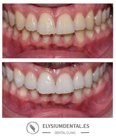 Blanqueamiento dental en Madrid