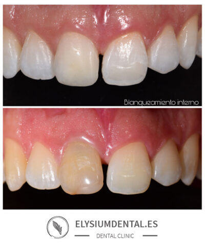 Blanqueamiento dental en Madrid