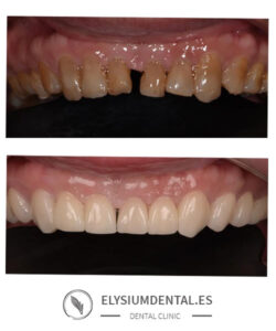 Carillas de zirconio en barrio de Salamanca