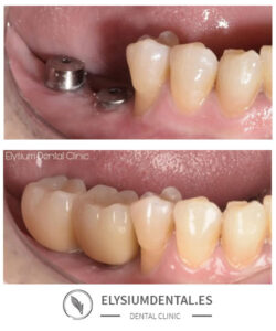 Carillas de zirconio en barrio de Salamanca