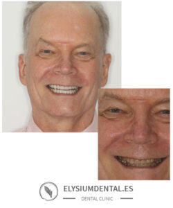 Carillas de zirconio en Madrid