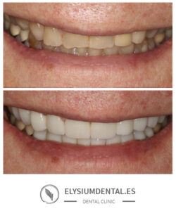 Carillas de zirconio en barrio de Salamanca