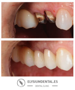 Carillas de zirconio en Madrid