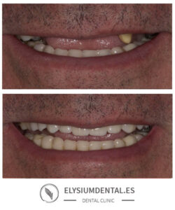 Carillas de zirconio en barrio de Salamanca