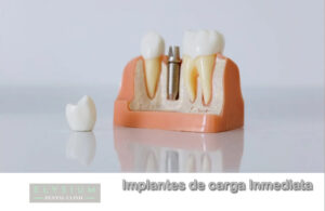 Immediate load implants