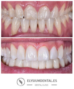 Carillas de zirconio en barrio de Salamanca