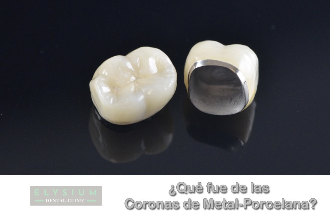 Las coronas dentales metal porcelana