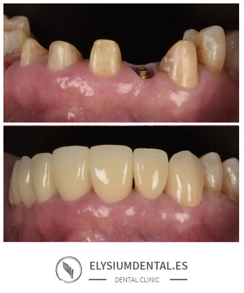 Carillas de zirconio en Madrid