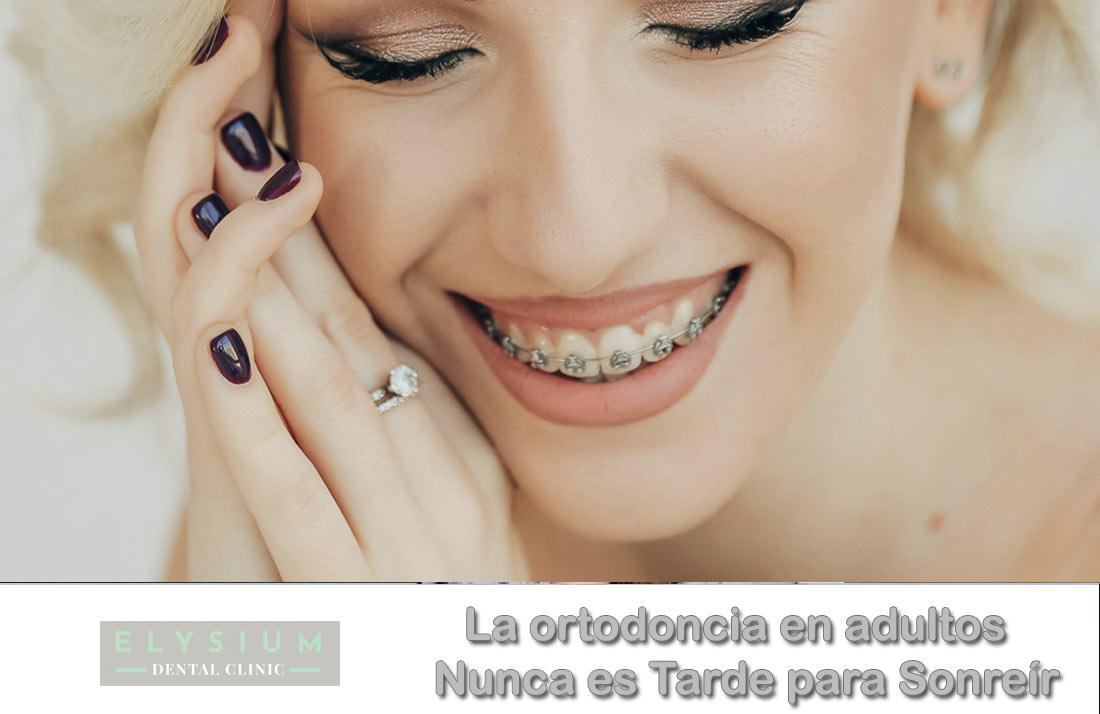 La ortodoncia en adultos