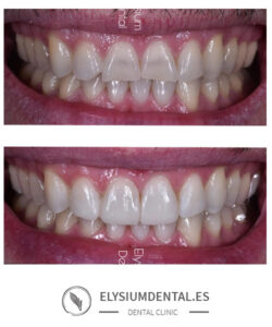 Carillas de zirconio en barrio de Salamanca