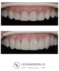 Carillas de zirconio en barrio de Salamanca