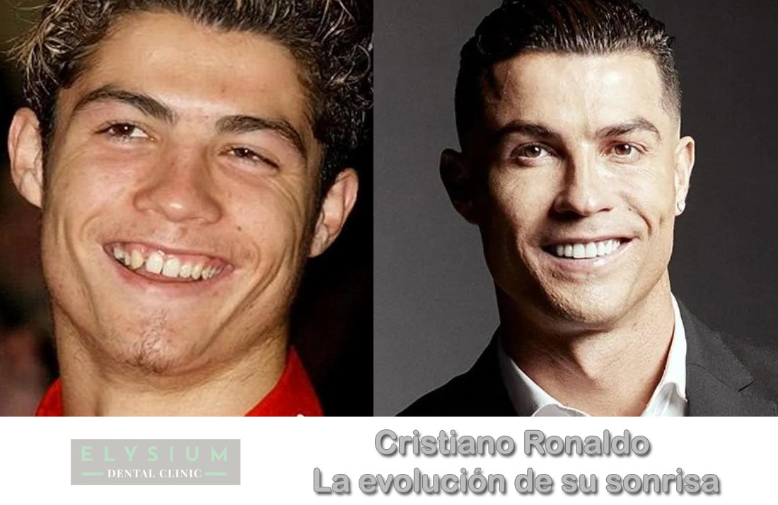 la evolucion de la sonrisa de cristiano ronaldo
